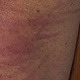 Whipped back - a few days later